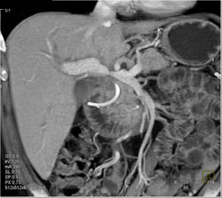 Narrowed Portal Vein Anastomosis in Liver Transplant Patient - CTisus CT Scan