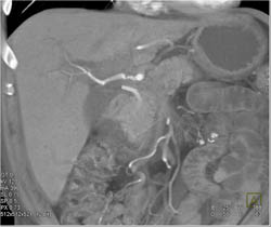 Encased Hepatic Artery Due to Cholangiocarcinoma - CTisus CT Scan