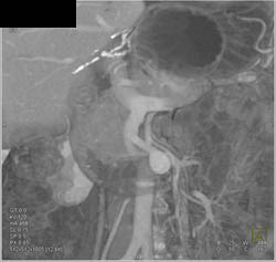 Portal Vein Aneurysm - CTisus CT Scan