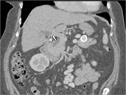 Splenic Artery Aneurysm - CTisus CT Scan