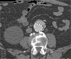 Endoleak - CTisus CT Scan