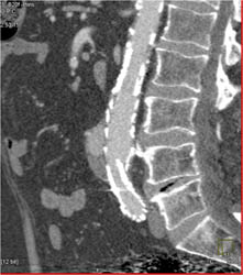 Endoleak - CTisus CT Scan