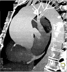 Dilated Aortic Root - CTisus CT Scan