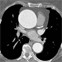 Dilated Aortic Root - CTisus CT Scan