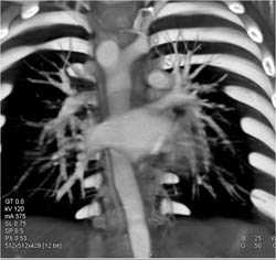 Aortic Vascular Ring With Attempt at Double Arch With Airway Compression - CTisus CT Scan