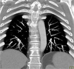 Pulmonary Embolism - CTisus CT Scan