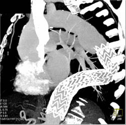 Endovascular Stent With Ulcer Above Stent - CTisus CT Scan