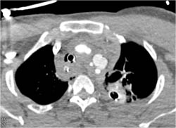 GSW to Neck With Bleeding Off Arch - CTisus CT Scan