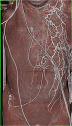 Collaterals in Abdominal Wall Due to SVC Compression - CTisus CT Scan