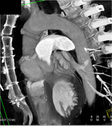 Ascending Aortic Repair With Dilated Sinus of Valsalva - CTisus CT Scan