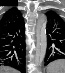 Aortic Dissection - CTisus CT Scan