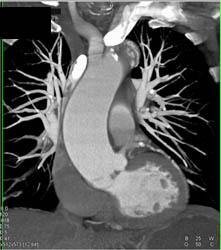 Dilated Ascending Aorta - CTisus CT Scan