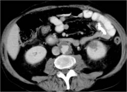 Renal Infarcts and Ulcerations in Aorta - CTisus CT Scan