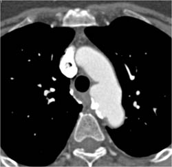 Ductus Aneurysm - CTisus CT Scan