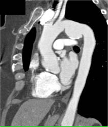 Ductus Aneurysm - CTisus CT Scan