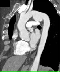 Ductus Aneurysm - CTisus CT Scan