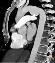 Ductus Aneurysm - CTisus CT Scan