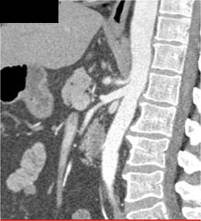 Median Arcuate Ligament Syndrome - CTisus CT Scan