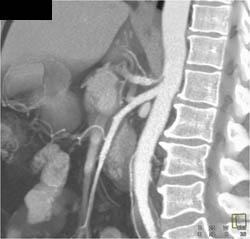 Median Arcuate Ligament Syndrome - CTisus CT Scan