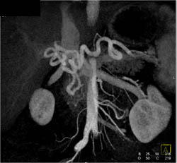 Median Arcuate Ligament Syndrome - CTisus CT Scan