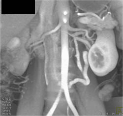 Unusual Venous Anatomy in A Potential Renal Donor - CTisus CT Scan