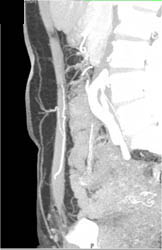 Arterial Mapping for Planning DIEP Or Deep Flap Reconstructive Surgery - CTisus CT Scan