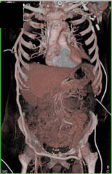 Axillary-fem Shunt - CTisus CT Scan