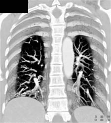 Embolized Left Pulmonary Arteriovenous Malformation (PAVM) - CTisus CT Scan