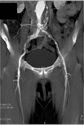 Iliac Artery Disease With Bone Removal Analysis - CTisus CT Scan