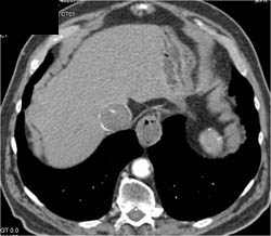 IVC Clot Due to Primary IVC Sarcoma - CTisus CT Scan