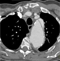 Type A Dissection - CTisus CT Scan