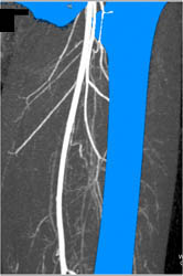 Normal SFA S/P GSW - CTisus CT Scan