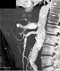 Celiac Artery Aneurysm - CTisus CT Scan