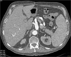 Celiac Artery Aneurysm - CTisus CT Scan