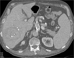 Celiac Artery Aneurysm - CTisus CT Scan