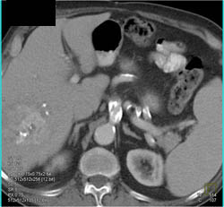 Celiac Artery Aneurysm - CTisus CT Scan