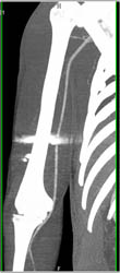 GSW Arm W/o Vascular Injury But Artifact Causes Pseudo-lesion - CTisus CT Scan