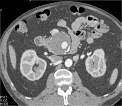 SMA Artery Aneurysm - CTisus CT Scan