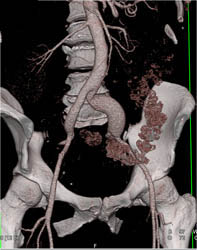 Iliac Artery Aneurysm - CTisus CT Scan