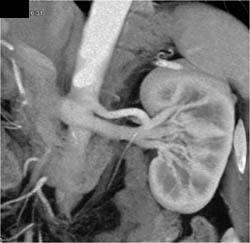 Normal Renal Artery and Vein With Various Renderings - CTisus CT Scan