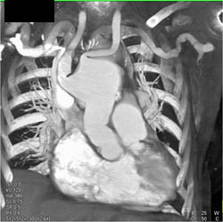 Aortic Aneurysm Without Dissection - CTisus CT Scan