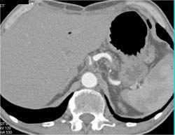 Celiac Stenosis Due to Plaque - CTisus CT Scan