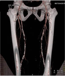 Peripheral Vascular Disease (PVD) With Diseased SFAs - CTisus CT Scan