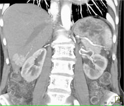 Focal Nodular Hyperplasia (FNH) - Feeding Vessel to Vascular Mass. Mass Is Vascular But Similar to IVC - CTisus CT Scan