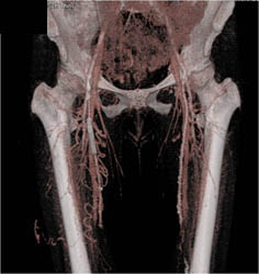 Peripheral Vascular Disease (PVD) With Stenosis SFA - CTisus CT Scan