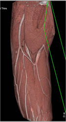 Normal Vascular and Muscle Anatomy at the Elbow - CTisus CT Scan