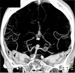 Basilar Artery Aneurysm - CTisus CT Scan