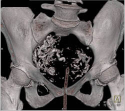 Pelvic Arteriovenous Malformation (AVM) S/P Coiling - CTisus CT Scan