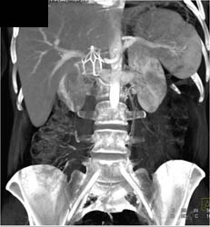 IVC Filter High in Position - Vascular Case Studies - CTisus CT Scanning