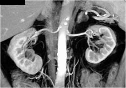 2 Right Renal Arteries in A Donor - CTisus CT Scan